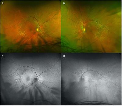 Case report: Pemigatinib-induced retinopathy: a serial examination of subretinal fluid secondary to an FGFR inhibitor